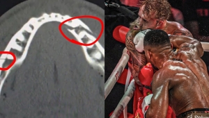 JAKE PAUL Z POŁAMANĄ ŻUCHWĄ 