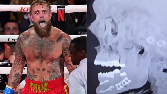 JAKE PAUL PO OPERACJI ŻUCHWY - BĘDZIE PAMIĄTKA PO WALCE Z JOSHUĄ